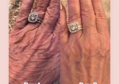 Marine Collagen Elixir Before & After treatment difference on the hands