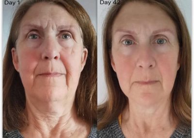 Marine Collagen Elixir Before & After treatment whole face