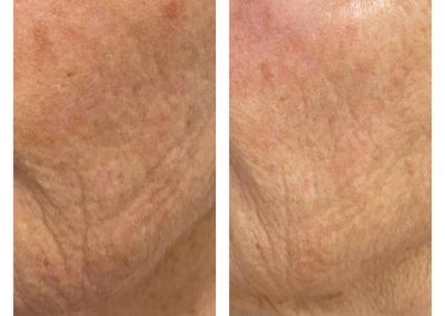 Marine Collagen Elixir Before & After treatment on the cheek