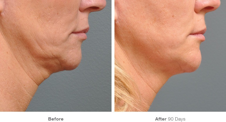 non surgical facelift before and after